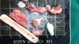 Phẫu thuật thẩm mỹ nâng mũi 6 lần Việt kiều gặp họa